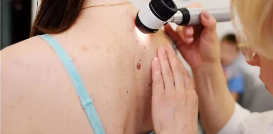 Απίστευτα νέα: Αρχίζει στην Ελλάδα μελέτη με το πρώτο εμβόλιο για το μελάνωμα – «Πιθανότατα βρισκόμαστε σε μια επανάσταση κατά του καρκίνου»