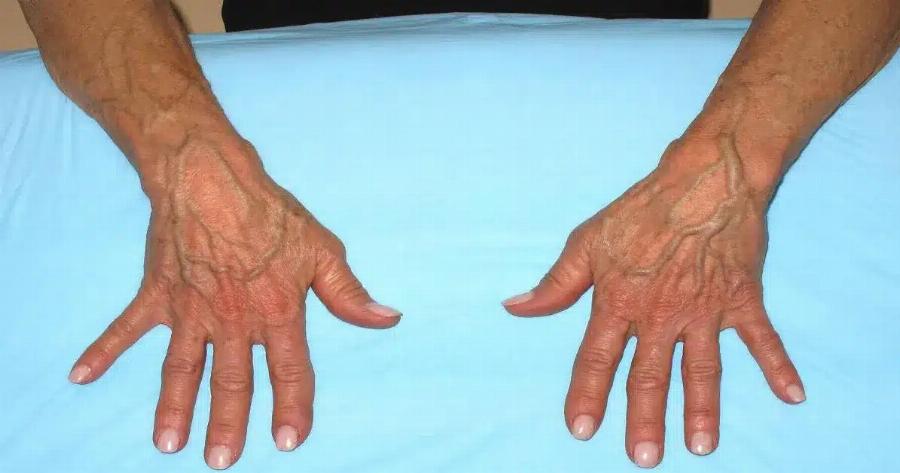 Πότε να ανησυχείτε για τις φλέβες που εμφανίζονται ξαφνικά