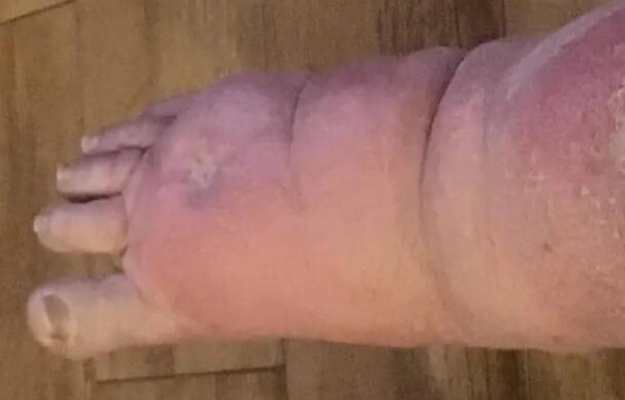 Απίστευτο Σοκ Πατέρας 46 χρονών έχασε το πόδι του από δάγκωμα