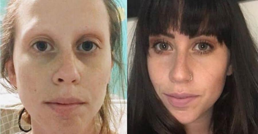 Μία 25χρονη που viκnσε τον Kαpκivo του δέρματος λέει ποια προϊóντα δεν θα χρησιμοποιήσει ξανά