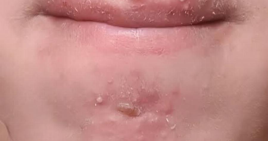 Έβγαινα με μια γυναίκα που γνώρισα στο σουπερμάρκετ και αφού τελικά πήγα μαζί της ξύπνησα με αυτά στο πρόσωπό μου. Τι είναι αυτό;