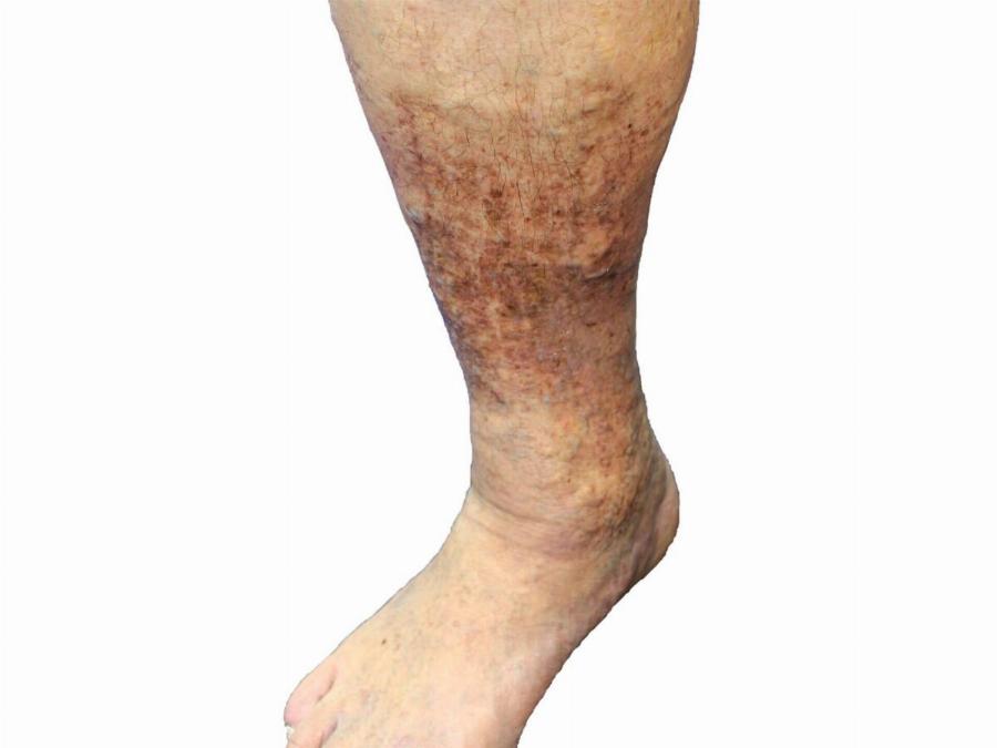 EKTAKTH ΕΙΔΗΣΗ – Παγκόσμια Avnσuxiα για τον Ντόναλντ Τραμπ – Με τι διαγνώστηκε