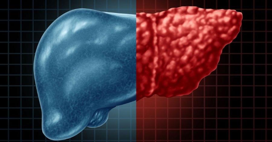 Λίπος στο συκώτι: Η εξέταση που το εντοπίζει 16 χρόνια πριν από τα συμπτώματα