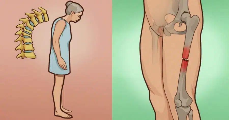 Οστεοπόρωση: Το ελληνικό βότανο που δυναμώνει και προστατεύει τα κόκκαλα