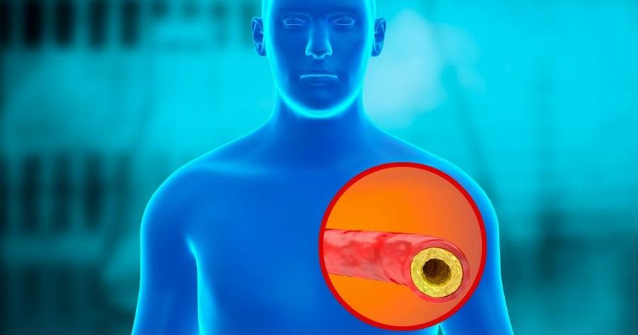 Η εξέταση που προβλέπει τον κίνδυνο θανάτου από καρδιακό επεισόδιο εντός πενταετίας