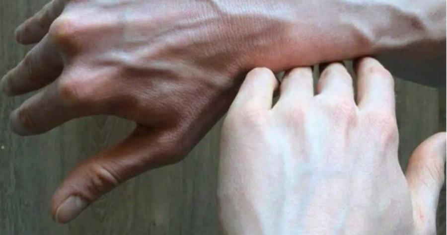 Αν δείτε κάποιον με διογκωμένες φλέβες, πρέπει να του πείτε αυτά τα πράγματα