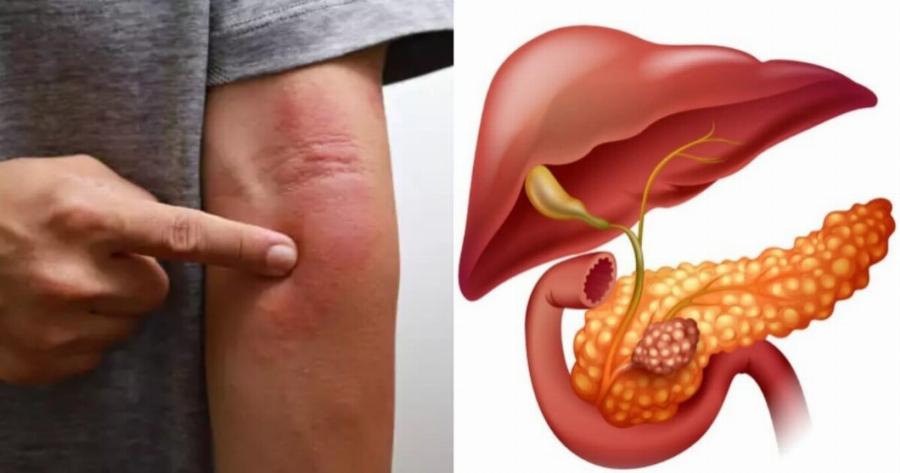 Καρκίνος: Έξι ύποπτα σημάδια που προειδοποιούν για τη νόσο – Τι πρέπει να κάνετε