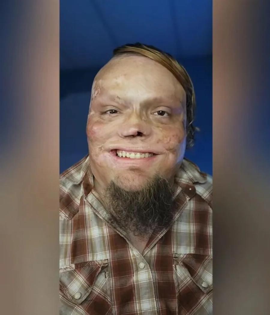 «Υπέστη έγκαυμα στο 98% του σώματός του ως παιδί, τον εγκατέλειψε η σύζυγός του»: Μεγάλωσε μόνος του τις 2 κόρες του