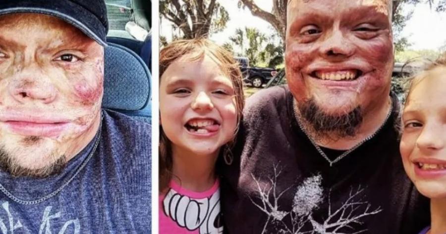 «Υπέστη έγκαυμα στο 98% του σώματός του ως παιδί, τον εγκατέλειψε η σύζυγός του»: Μεγάλωσε μόνος του τις 2 κόρες του