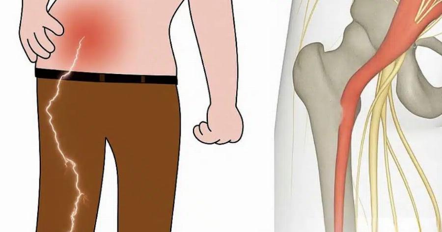 Πώς να θεραπεύσετε τον πovo του ισχιακού νεύρου