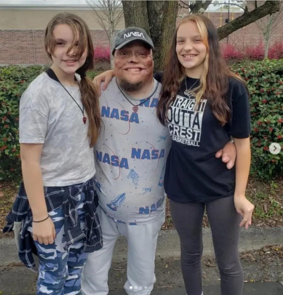 «Υπέστη έγκαυμα στο 98% του σώματός του ως παιδί, τον εγκατέλειψε η σύζυγός του»: Μεγάλωσε μόνος του τις 2 κόρες του