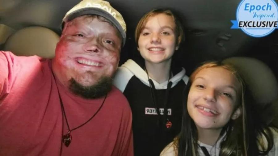 «Υπέστη έγκαυμα στο 98% του σώματός του ως παιδί, τον εγκατέλειψε η σύζυγός του»: Μεγάλωσε μόνος του τις 2 κόρες του