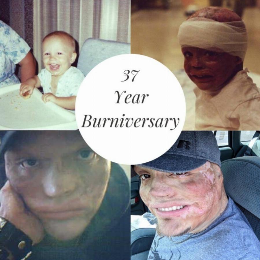 «Υπέστη έγκαυμα στο 98% του σώματός του ως παιδί, τον εγκατέλειψε η σύζυγός του»: Μεγάλωσε μόνος του τις 2 κόρες του