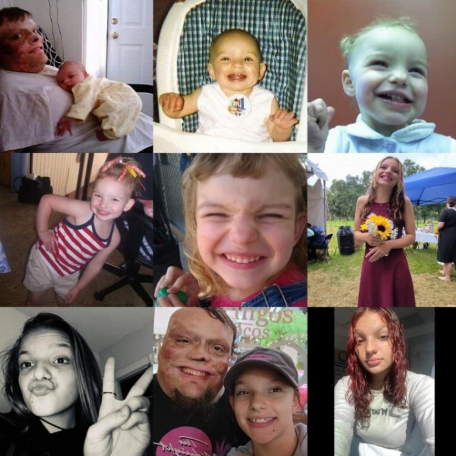 «Υπέστη έγκαυμα στο 98% του σώματός του ως παιδί, τον εγκατέλειψε η σύζυγός του»: Μεγάλωσε μόνος του τις 2 κόρες του