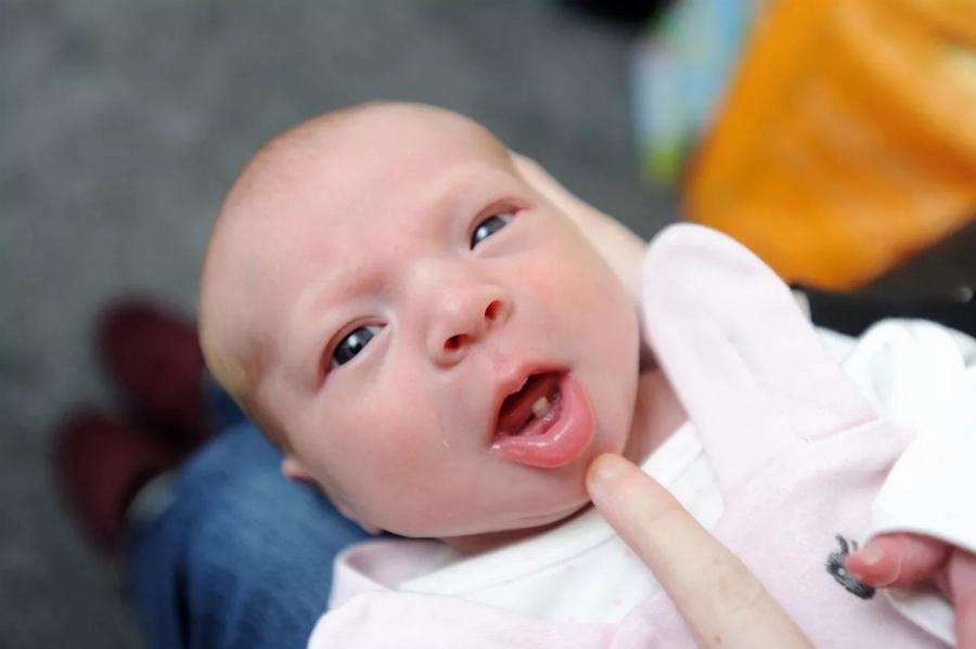 18χρονη γέννησε μετά από 4 ώρες τοκετού – Μόλις οι γιατροί είδαν το στόμα του μωρού έπαθαν ΣOK