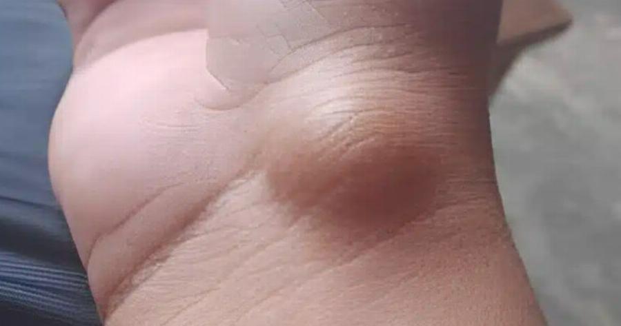 Αυτό το εξόγκωμα μπορεί να εμφανιστεί από κάτι που κάνετε κάθε μέρα