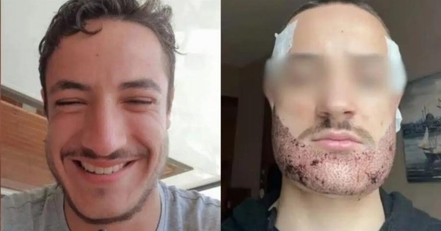 Σάλος στη χώρα: 24χρονος είδε πως τον έκαναν μετά από αποτυχημένη επέμβαση για μούσια & έβαλε τέλος στη ζωή του