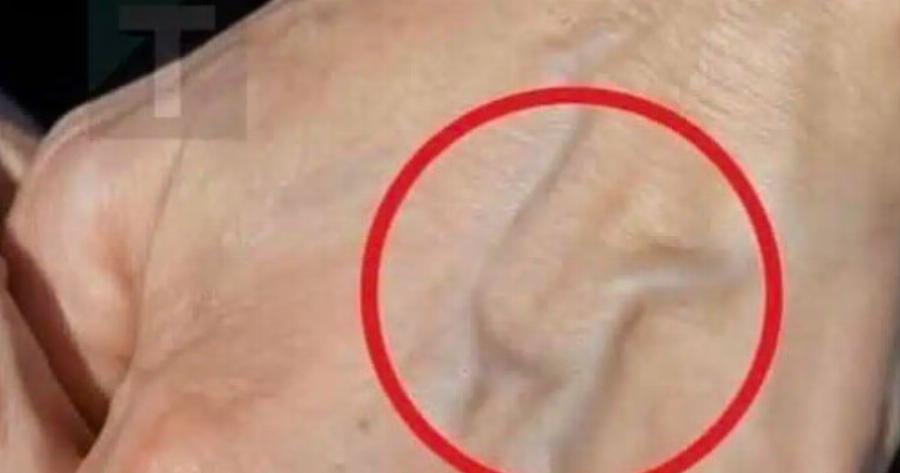 Φυσικές θεραπείες για τη βελτίωση της υγείας των φλεβών και του δέρματός σας