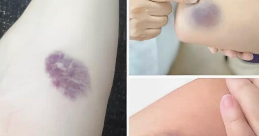 ΠΡΟΣΟΧΗ! Αν εμφανιστούν τέτοιες μελανιές στο σώμα σας, σημαίνει ότι έχετε…