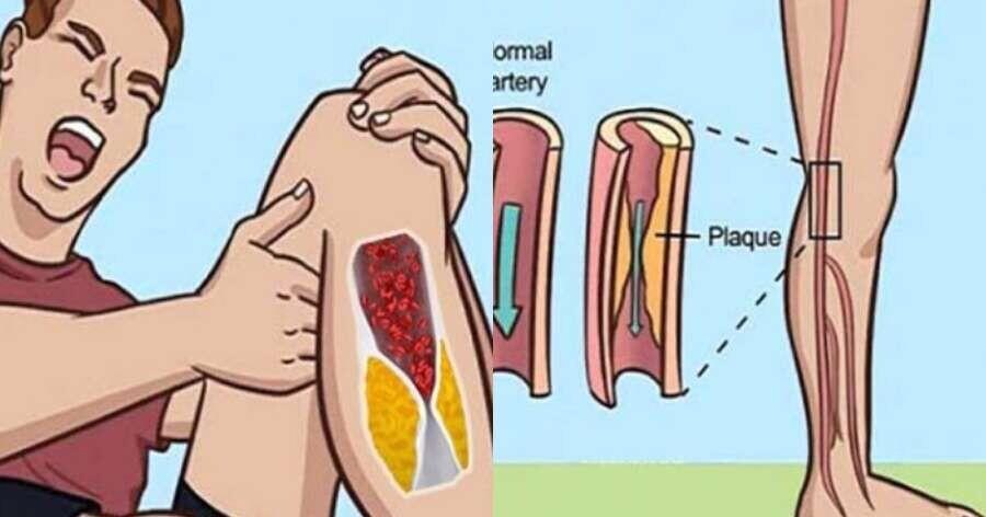 Μήπως έχετε φραγμένες αρτηρίες; Κάντε άμεσα το τεστ με το μαξιλάρι