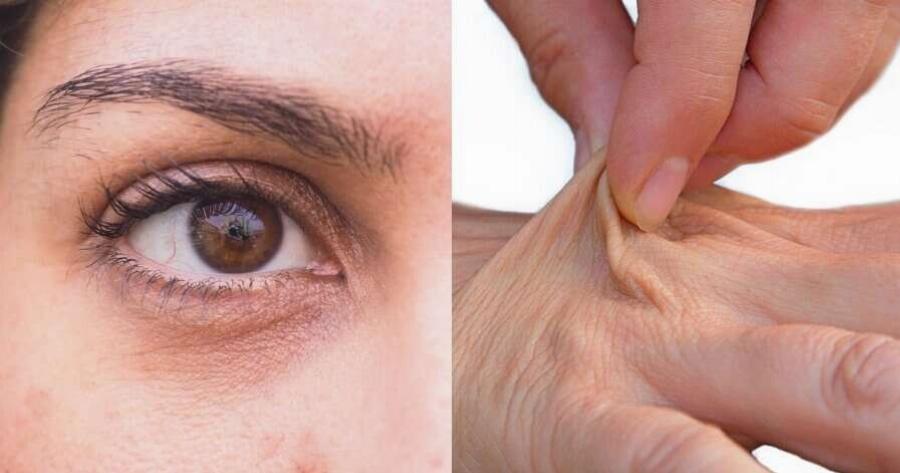 Πρόωρη γήρανση: 5 τροφές που στεγνώνουν το δέρμα, δημιουργούν φλεγμονή και σας κάνουν να φαίνεστε μεγαλύτερες