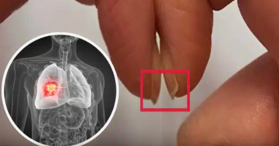 Τεστ με τα δάκτυλα για καρκίνο του πνεύμονα θα μπορούσε να προσδιορίσει τον κίνδυνο καρκίνου