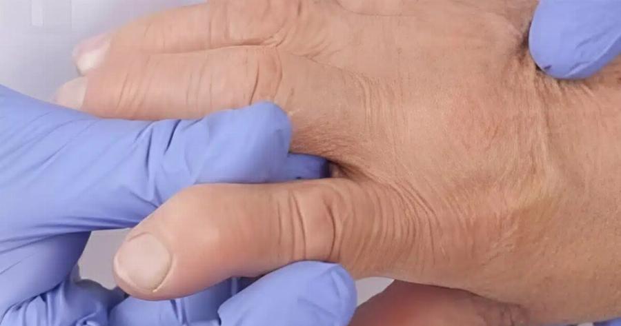 Τρόφιμα που πρέπει να αποφύγετε όταν έχετε ρευματοειδή αρθρίτιδα