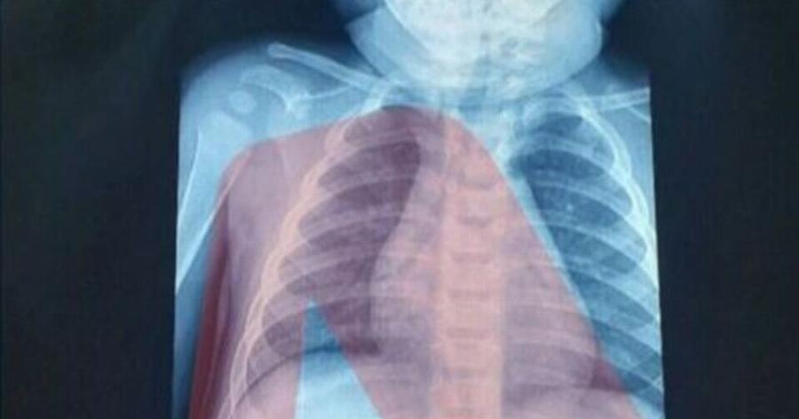 Αθήνα: Απίστευτο αυτό που είδαν οι γιατροί στην ακτινογραφία του 3χρονου! Είχε στο στομάχι του…
