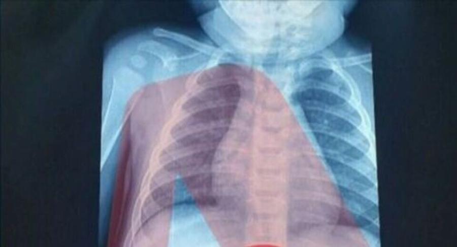 Αθήνα: Απίστευτο αυτό που είδαν οι γιατροί στην ακτινογραφία του 3χρονου! Είχε στο στομάχι του…