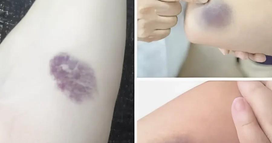 ΠPOΣOXH! Αν εμφανιστούν τέτοιες μελανιές στο σώμα σας, σημαίνει ότι έχετε…