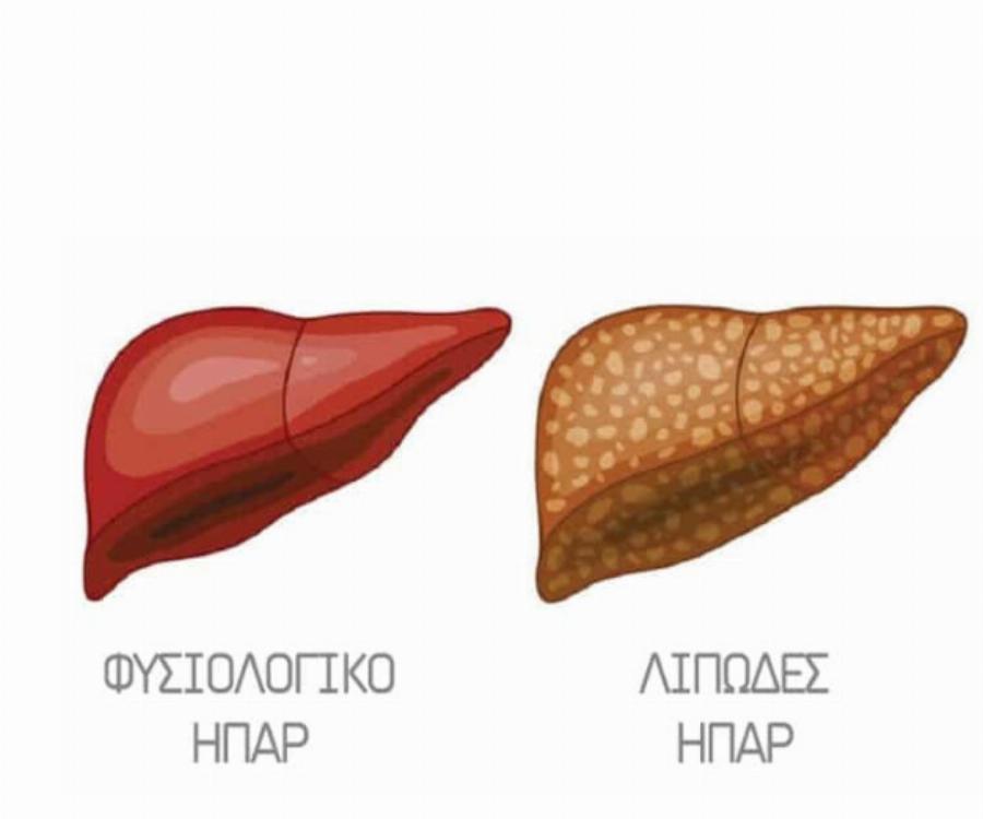 Πώς μας προειδοποιεί το συκώτι ότι είναι υπερφορτωμένο