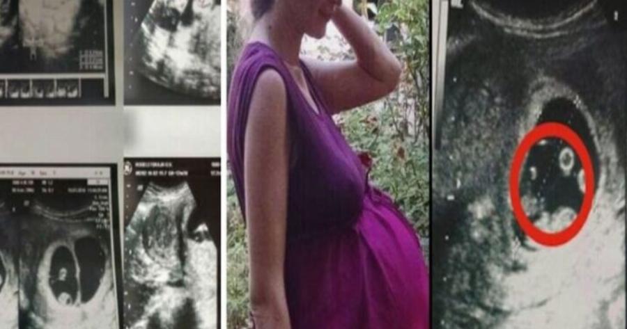 Όταν οι γιατροί είδαν το υπερηχογράφημα 36χρονης εγκύου φοβήθηκαν να την αγγίξουν – Δεν είχαν αντιμετωπίσει ποτέ κάτι παρόμοιο