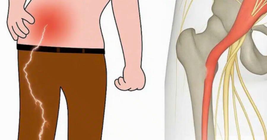 3 ασκήσεις για την ανακούφιση από τον ισχιαλγικό πόνο στο πόδι: πρακτικές και αποτελεσματικές