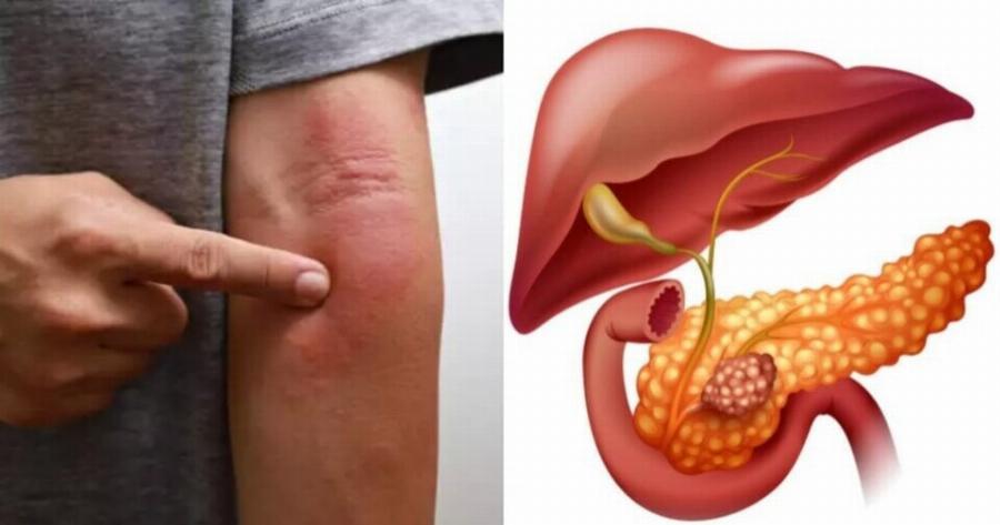 Το περίεργο σημάδι στο δέρμα που «δείχνει» καρκίνο στο πάγκρεας – Γρήγορα για εξετάσεις