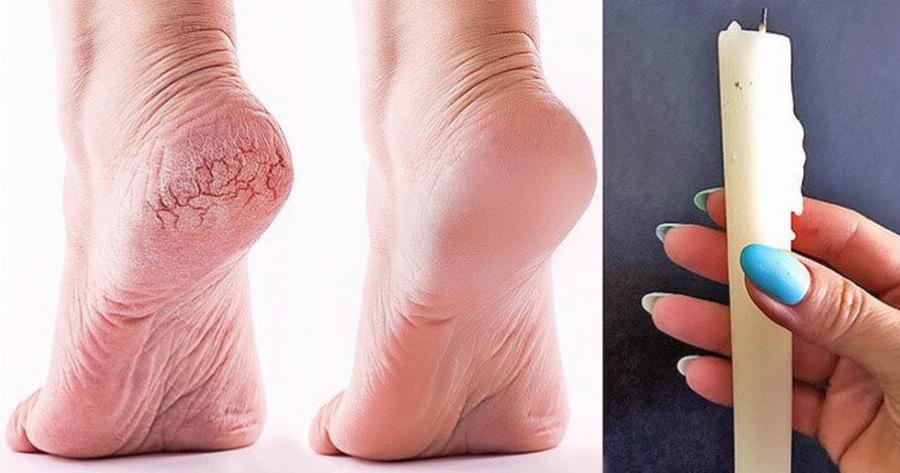 Κορίτσια σωθήκαμε: Το κόλπο με το κερί θα κάνει τις φτέρνες σας απαλές σαν μωρού, μέσα σε 15 λεπτά