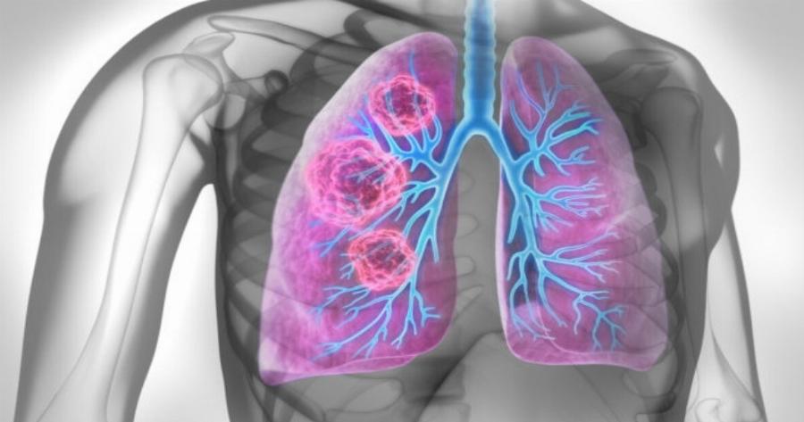 Δεν χρειάζεται να καπνίζετε για να πάθετε καρκίνο του πνεύμονα: Τι επιβάλλεται να έχετε στον νου σας!