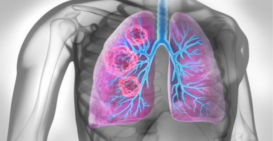 Δεν χρειάζεται να καπνίζετε για να πάθετε καρκίνο του πνεύμονα: Τι επιβάλλεται να έχετε στον νου σας!