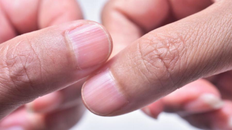 Προσοχή αν έχετε τέτοιο σημάδι κάπου στα νύχια σας –  Ένδειξη για συχνό καρκίνο