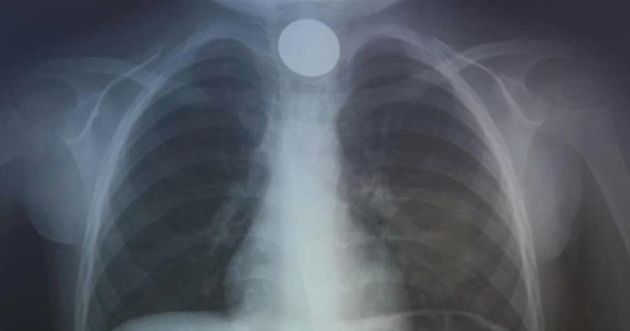 Είδαν αυτό στην ακτινογραφία & πάγωσαν: Αγωνία πρωτοχρονιάτικα για 4χρονο στην Κρήτη, έτσι τον έσωσαν οι γιατροί