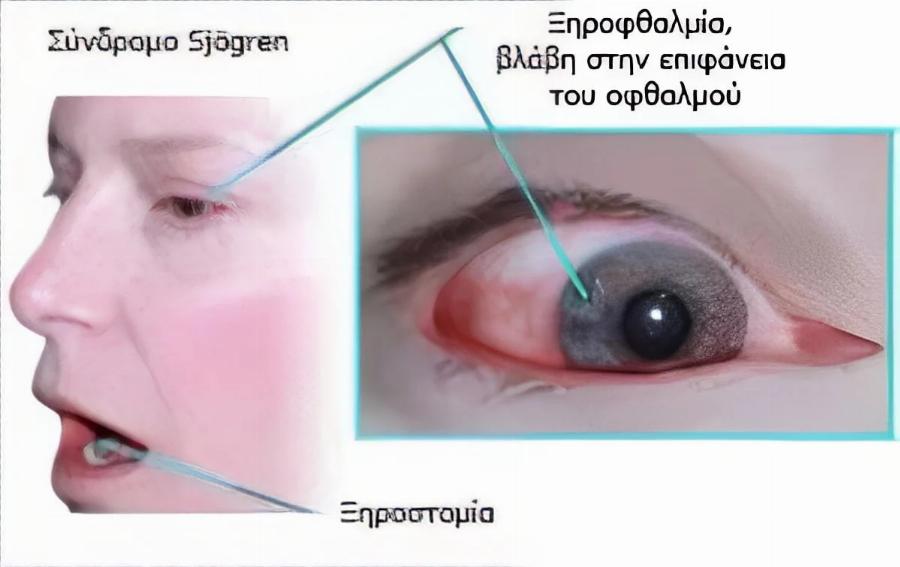 Το αυτοάνοσο νόσημα που μπορεί να κρύβει η ανεξήγητη κόπωση και ο πόνος στις αρθρώσεις