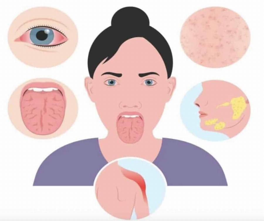 Το αυτοάνοσο νόσημα που μπορεί να κρύβει η ανεξήγητη κόπωση και ο πόνος στις αρθρώσεις