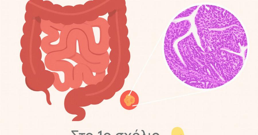 Το έντερο “μιλάει”: 5 πράγματα που δεν πρέπει να αγνοούμε για τον καρκίνο του παχέος εντέρου