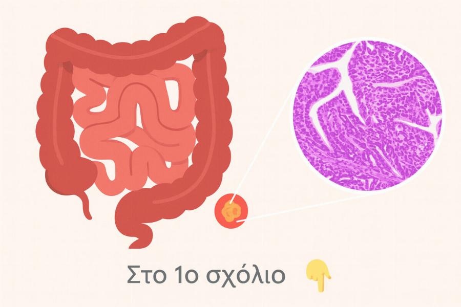 Το έντερο “μιλάει”: 5 πράγματα που δεν πρέπει να αγνοούμε για τον καρκίνο του παχέος εντέρου