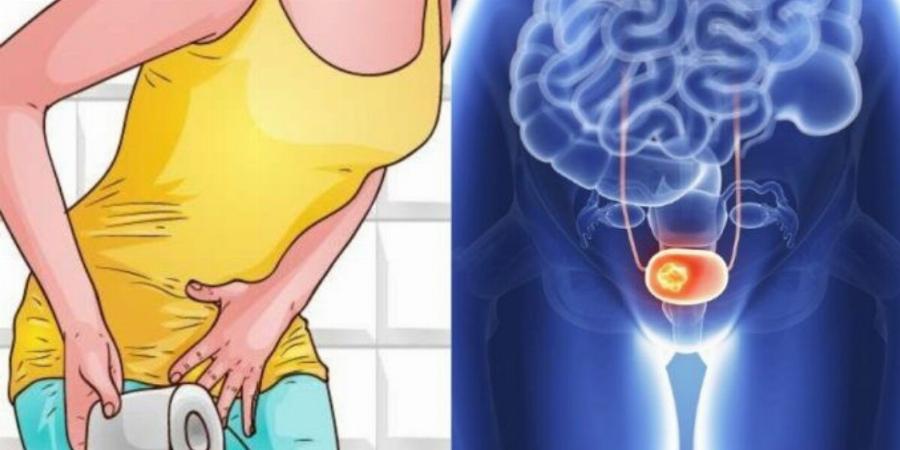 Ποια συμπτώματα μπορεί να κρύβουν έναν καρκίνο στην ουροδόχο κύστη και δεν τα φανταζόσασταν