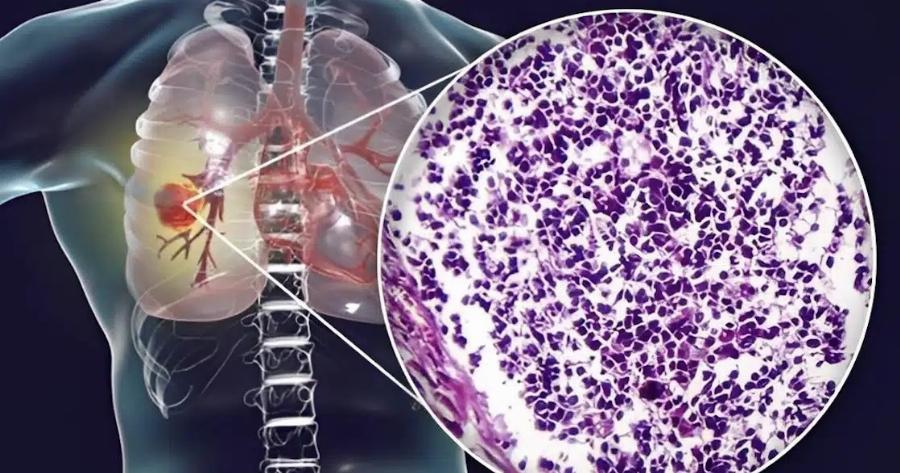 Ο αόρατος Kivδuvoς – Τι κοινό υλικό κουζίνας συνδέεται με Kαpκivo πνεύμονα – Πpoσoxn στο σπίτι σας