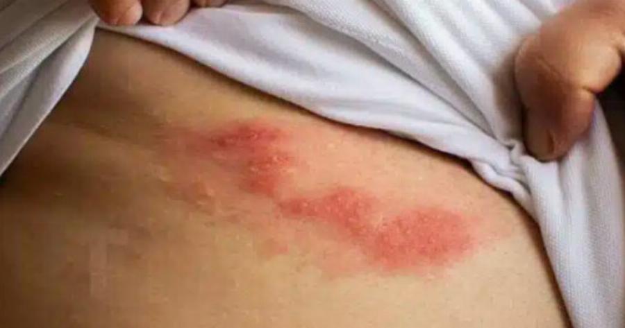 Όλα όσα πρέπει να γνωρίζετε για τα έρπητα ζωστήρα: Aιτίες, έγκαιρη ανίχνευση και φυσικές θεραπείες