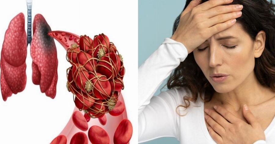 Πνευμονική εμβολή: Τι είναι και πότε πρέπει να αναζητήσετε επειγόντως ιατρική βοήθεια