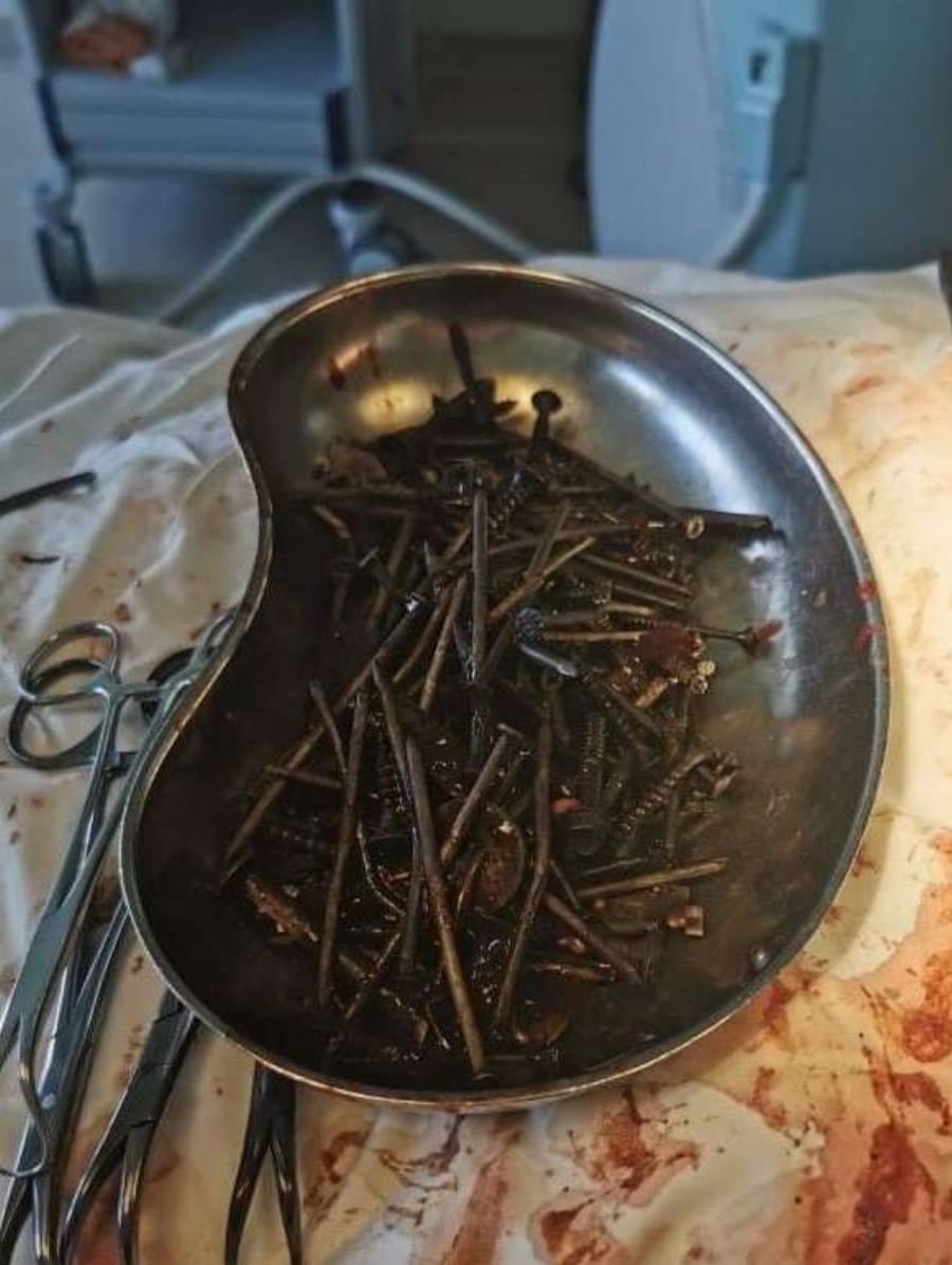 Πονούσε στην κοιλιά, πήγε στο νοσοκομείο και οι γιατροί έπαθαν ΣΟΚ με αυτό που είδαν..