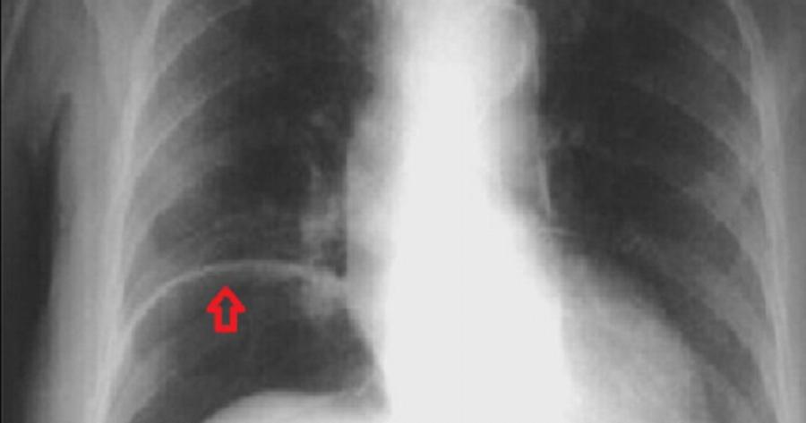 Πονούσε στην κοιλιά, πήγε στο νοσοκομείο και οι γιατροί έπαθαν ΣΟΚ με αυτό που είδαν..