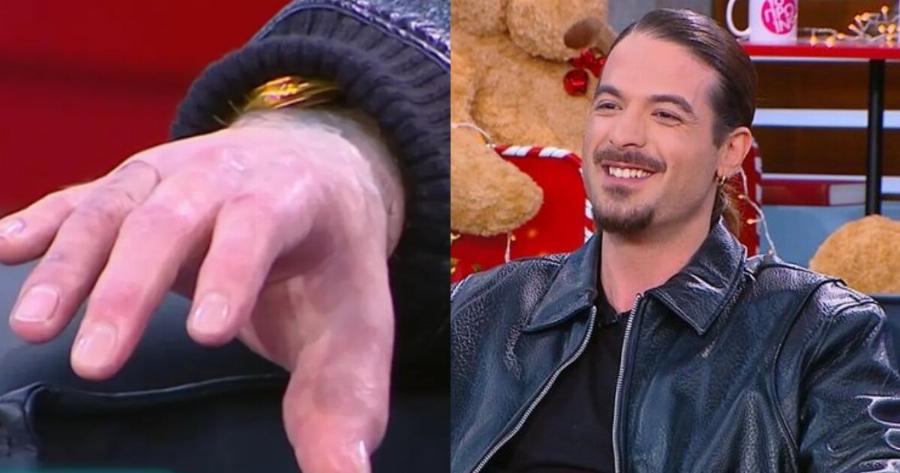 Ο Άρης Μουγκοπέτρος δείχνει για πρώτη φορά τα πρόσθετα δάχτυλά του